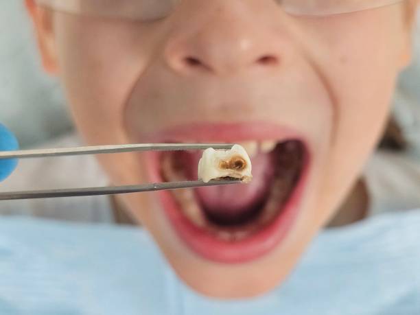 Best Emergency Broken Tooth Repair in Forest Lake, MN